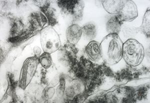 M, 71y. | melanoblastoma - promelanosomes M, 71y. | melanoblastoma - promelanosomes